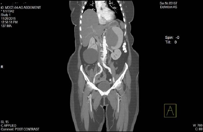 Kryhet operacioni i aneurizmës gjigante të arteries së shpretkës në veshkë