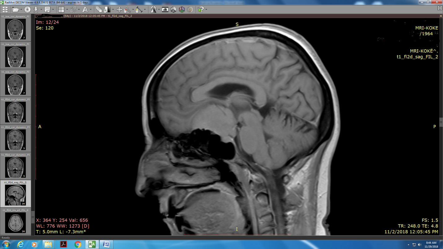 Realizohet me sukses tumori në sy në Klinikën e Neurokirurgjisë