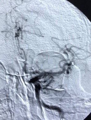 Kryhet rasti i parë në Kosovë në Stroke Center pacientit i shpëtohet jeta
